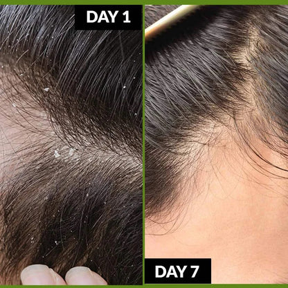 Herbal Onion Hair Growth Oil- 200 ml